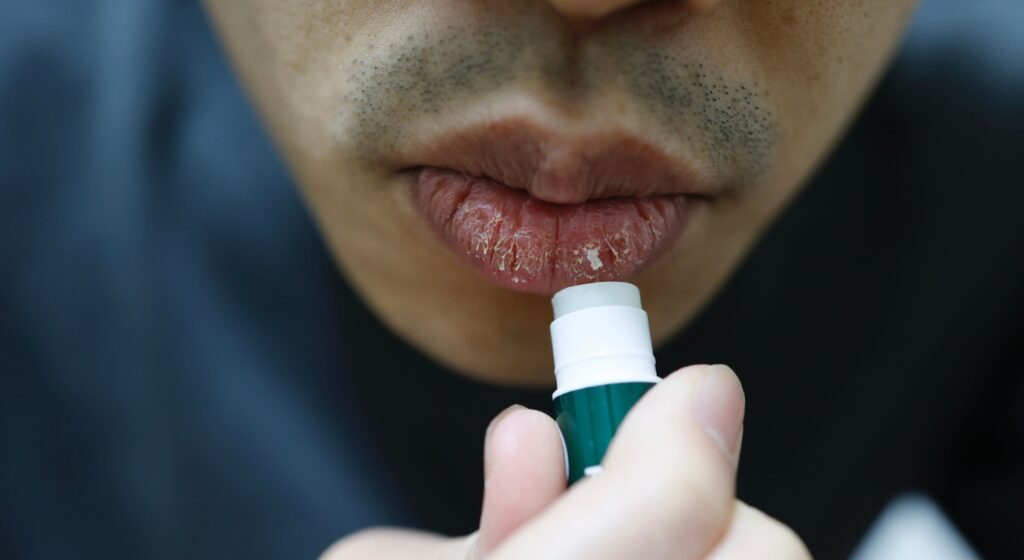 Labbra secche e screpolate in inverno: perché succede e come ripararle davvero
