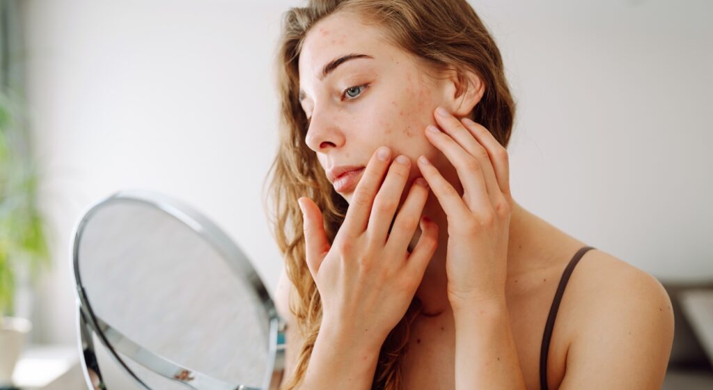 Pelle lucida e imperfezioni con i primi caldi: cosa succede e come riequilibrarla