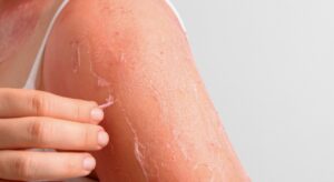 Pelle stressata dopo il sole: come lenire e idratare dopo mare e piscina